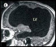 DWS: All of the black in the middle is water and the brain matter is the rim of white along the outside of the skull.  This is a screen shot from a Fox News report.